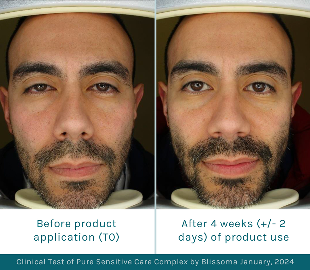 Before and after image of Blissoma's natural redness reduction cream clinical test results on a 37 year old hispanic man after 28 days of using an organic moisturizer and sensitive skin cleanser daily