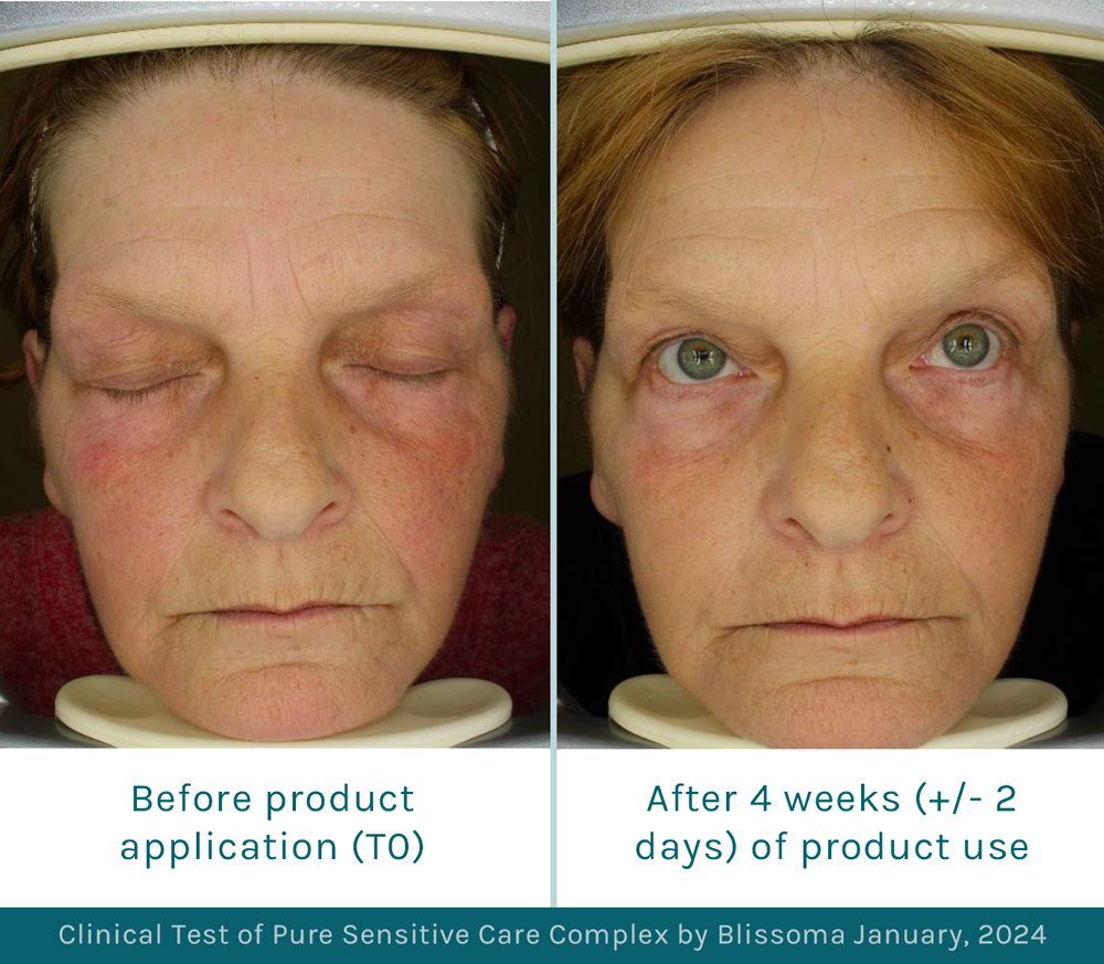 Before and after image of Blissoma's organic redness reduction cream clinical test results for a 62 year old white woman after 28 days of using an organic moisturizer and sensitive skin cleanser daily